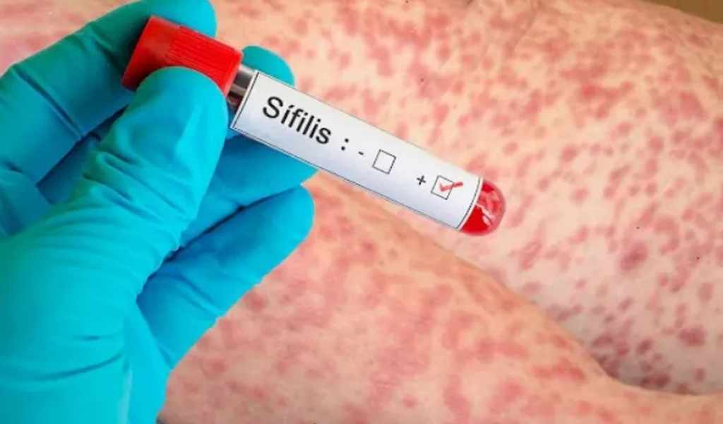 Sífilis: Las mujeres y los jóvenes entre los 20 y 29 años  son el sector con más contagios en la provincia de Salta