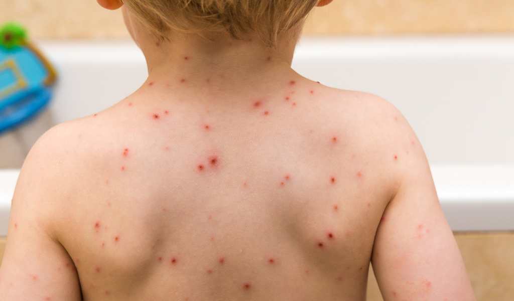 En Salta se registraron 509 casos de varicela en lo que va del 2025: "Esta enfermedad se previene con la vacunación"
