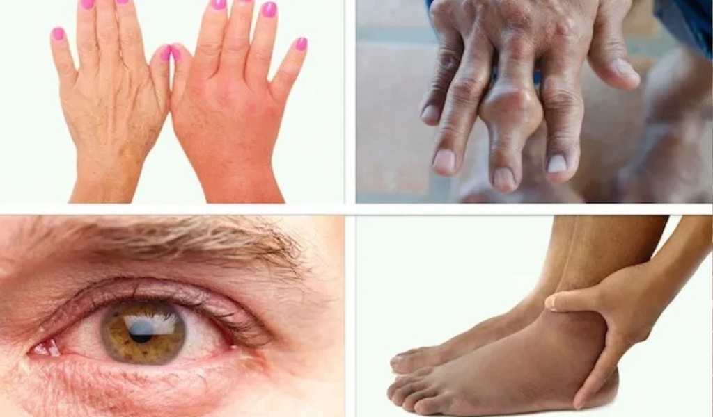 El virus que "encorva" por el dolor: Salta en alerta ante el avance de la fiebre chikungunya