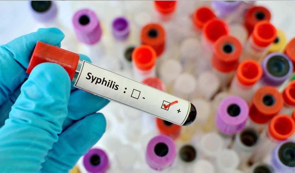 Preocupante aumento de casos de sífilis: advierten que los contagios avanzan con fuerza entre los 15 y los 39 años