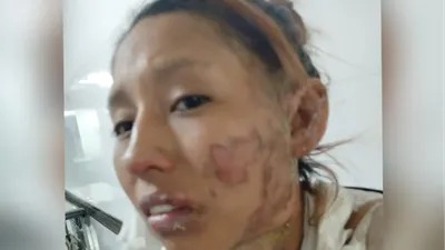 Conmoción en Orán por la desaparición de una joven quemada en el rostro por su pareja. El atacante está prófugo