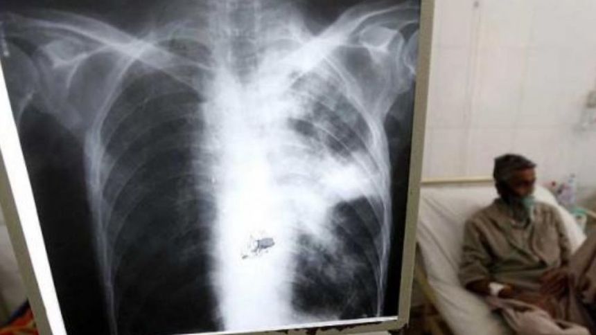 En Salta se registraron 400 casos de tuberculosis en lo que va del 2026