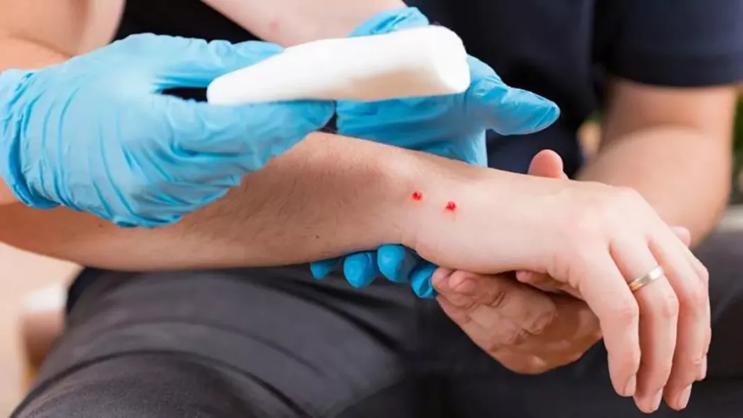 En lo que va del 2025, Salta ya registró más de 70 casos de picaduras de víbora