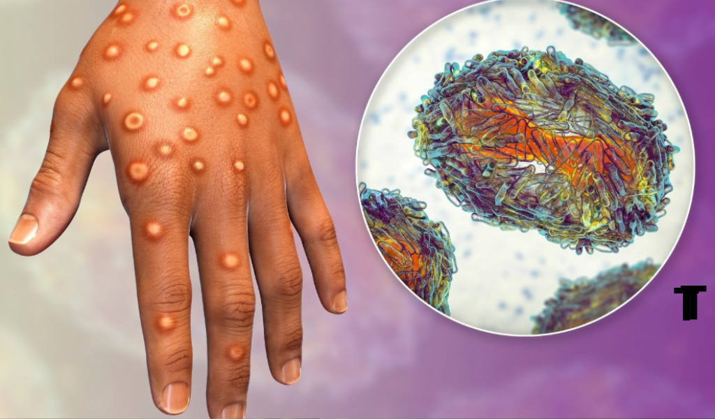 Casos de Viruela del Mono en la provincia: “Estas personas no salieron de Salta; alguien introdujo la enfermedad, y pasó las barreras sanitarias”