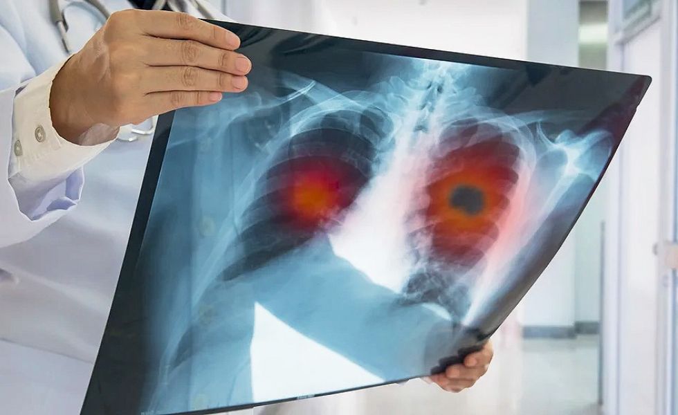 El ministro de Salud de Salta confirmó que actualmente son 19 los casos de tuberculosis detectados en cárceles de la provincia