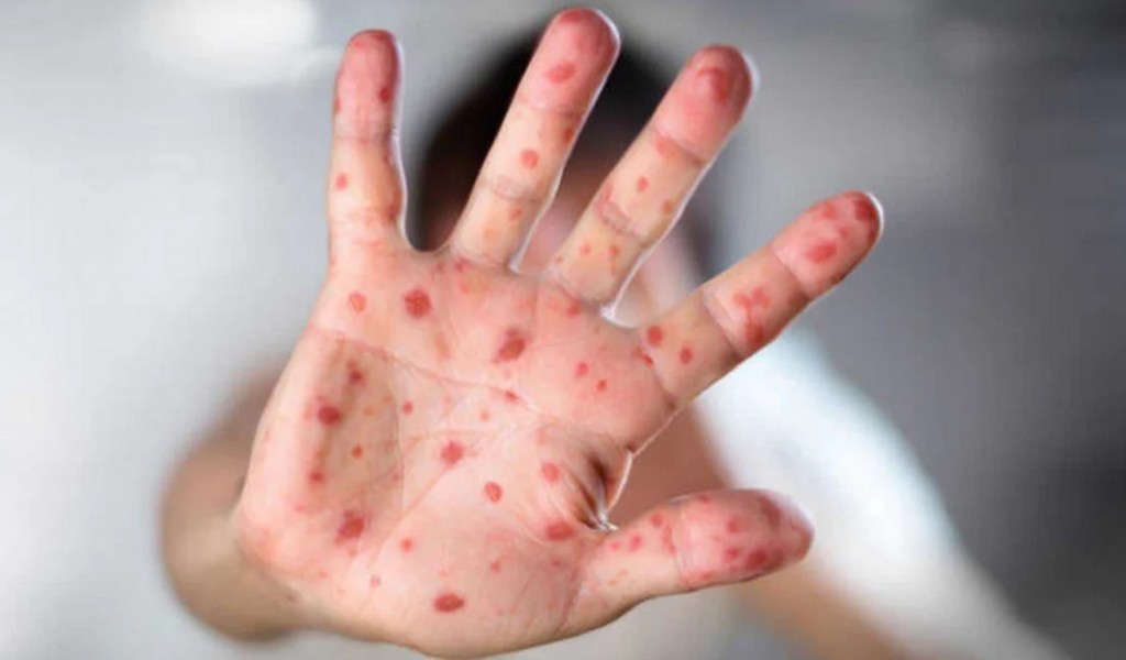 Emitieron una alerta  sanitaria por el aumento de casos de sarampión en Argentina