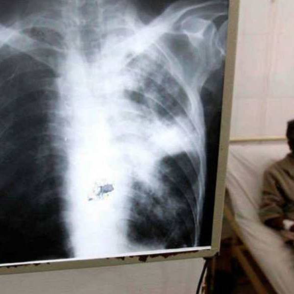 Salta es la provincia argentina con más contagios y muertes por tuberculosis: “Desde Bolivia llegan a nuestro país casos muy  graves