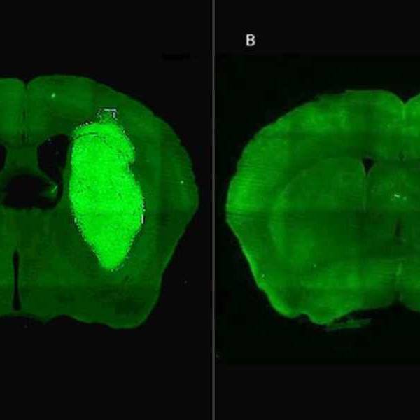 Avance médico: Científicos del CONICET desarrollaron una nueva estrategia para frenar tumores cerebrales cancerígenos