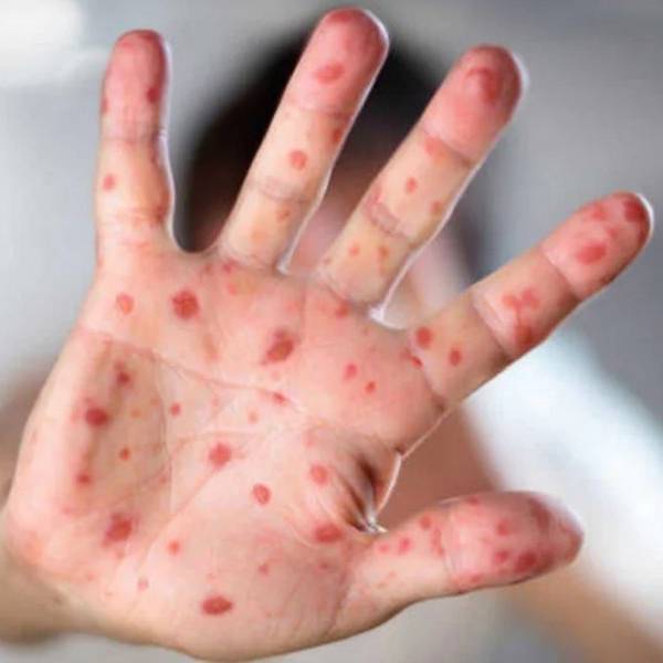 Emitieron una alerta  sanitaria por el aumento de casos de sarampión en Argentina