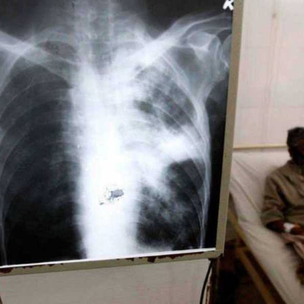 Argentina registra un preocupante aumento del 38% en nuevos casos de tuberculosis
