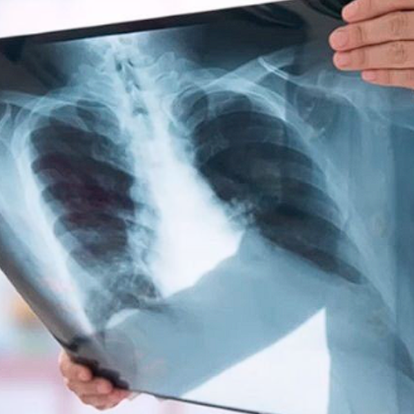 Salta es la provincia argentina con más contagios y muertes por tuberculosis: “Desde Bolivia llegan a nuestro país casos muy  graves